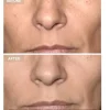 Anti-Aging LED Face Mask The Professional - Anti-aging LED-ansiktsmask