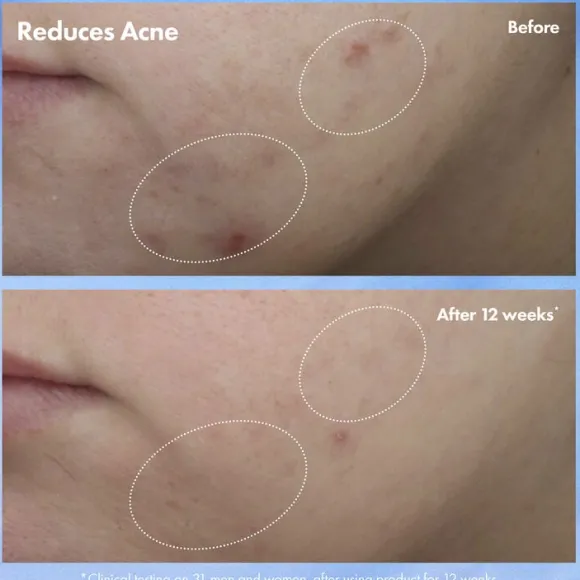 Clear Improvement Acne & Blackhead Clearing Hydrating Moisturizer Loti